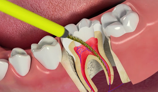 Root Canal Treatment